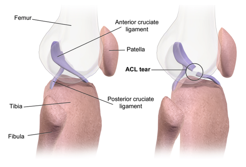 ACL rupture