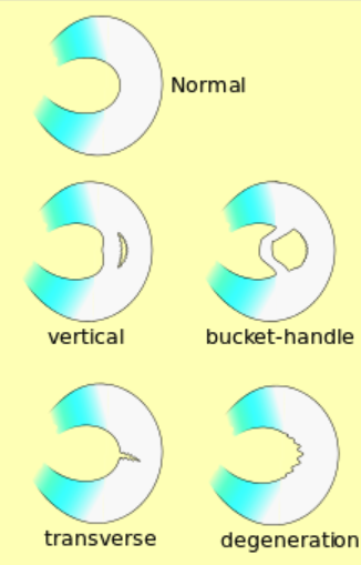 Meniscus tears