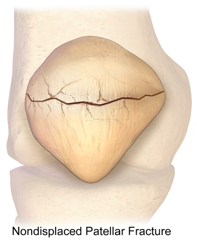 kneecap fracture