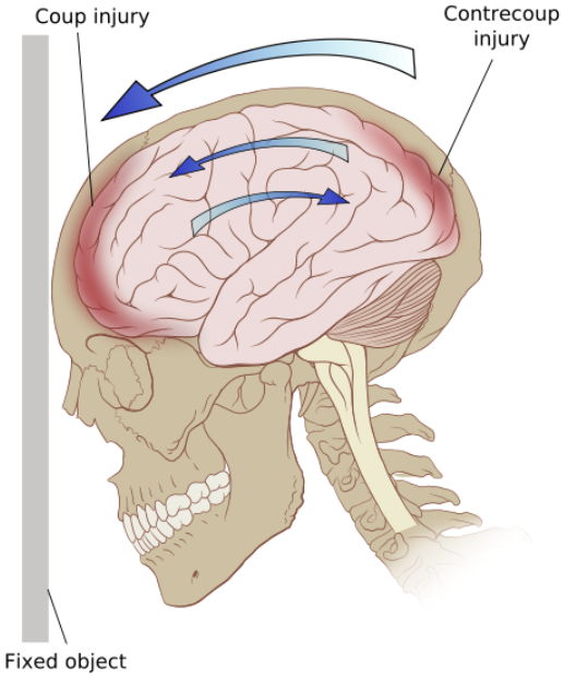 focal brain injury