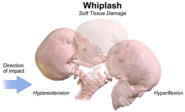 diffuse brain injury due to whiplash