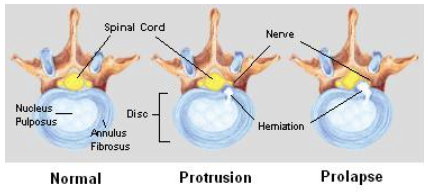 disc herniation