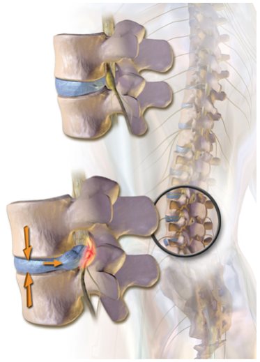 herniated lumbar disc