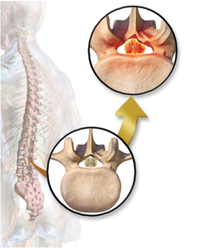 lumbar spinal stenosis