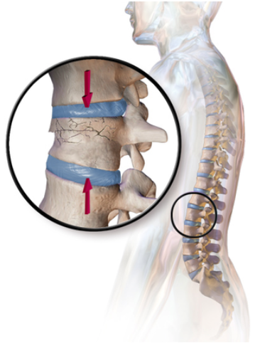 burst fracture in the lumbar vertebra