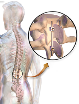 Stabilization rods used to fuse the vertebra