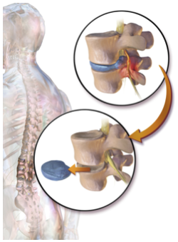 lumbar discectomy