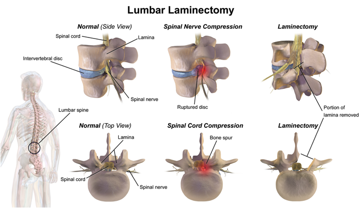 lumbar laminectomy